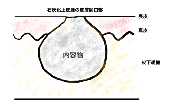 石灰化上皮腫の皮膚開口部